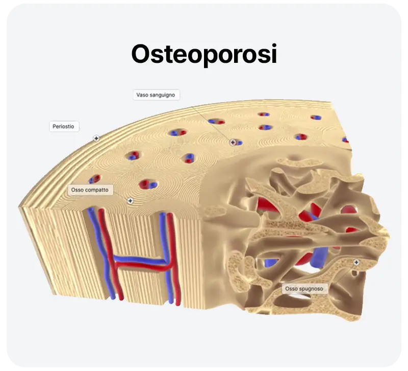 Osteoporosi nell'anziano