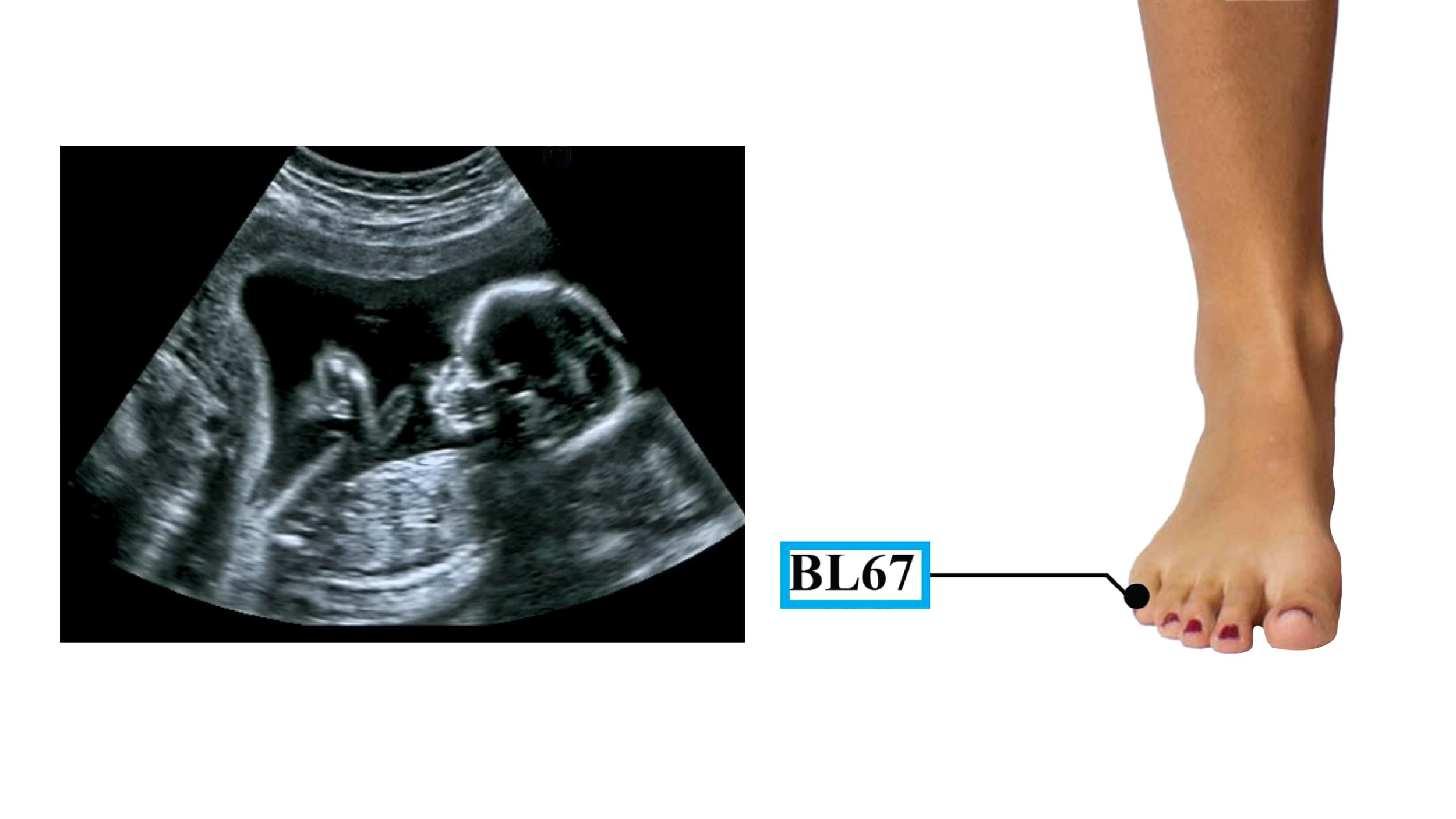 Moxibustione-Feto-Podalico